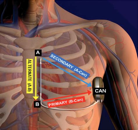 s icd implantation.